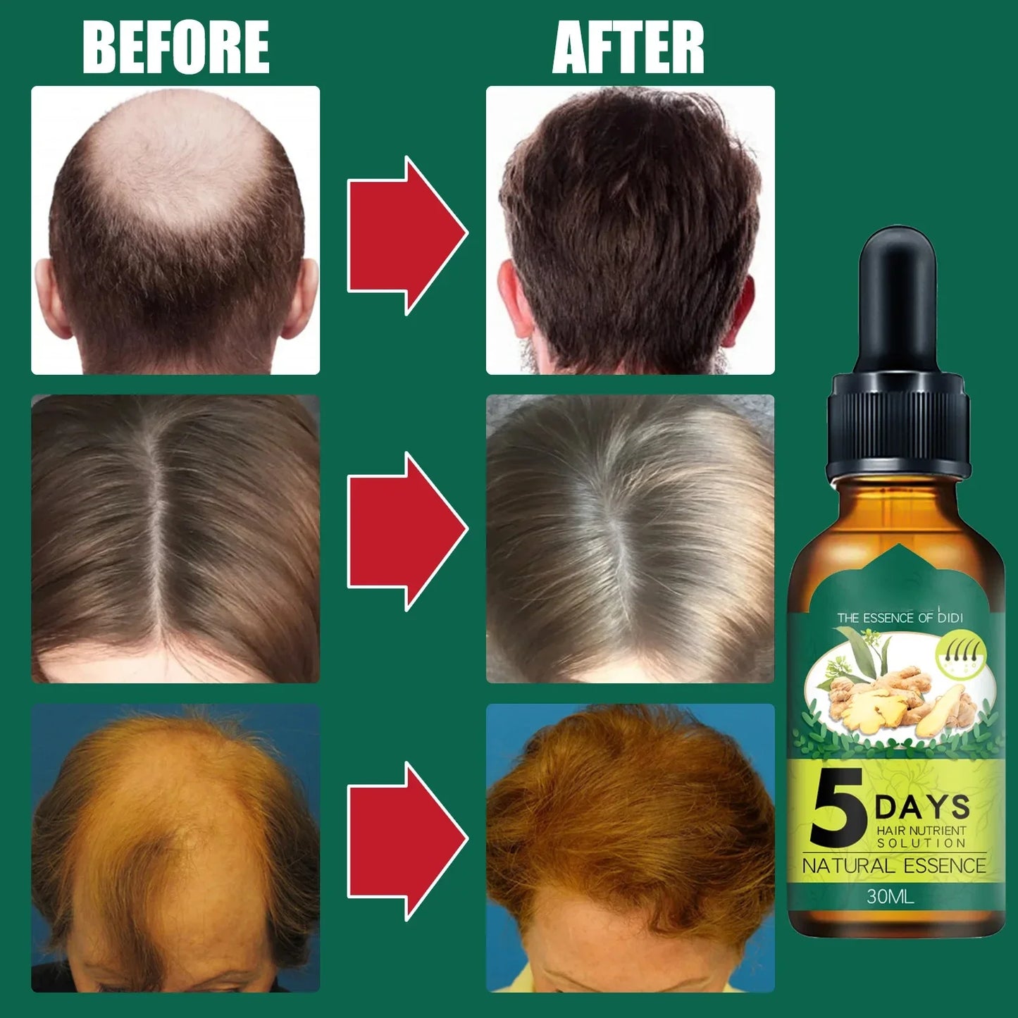 5 Days Ginger Hair Growth Oil Natural Anti Hair Loss Prevent Baldness Treatment Fast Growing Nourish Dry Damaged Hair Care