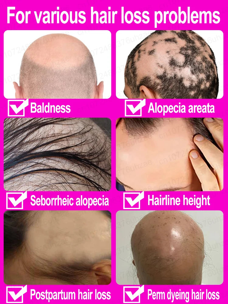 Unisex Hair Growth Oil Hair Loss Treatment Rapid Hair Growth Effective Baldness Repair Hereditary Postpartum Hair Loss