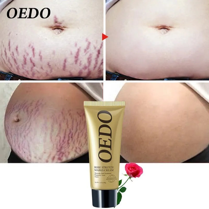 Rose Remove Stretch Marks Cream Anti Wrinkle Anti Aging Maternity Skin Repair Remove Pregnancy Scars Treatment Body Skin Care