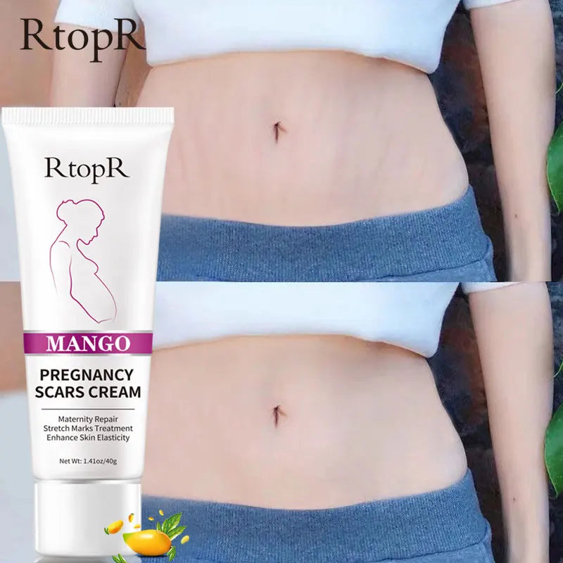 RtopR Pregnancy Scar Removal Cream Pregnant Women Pigment Correction Repair Body Gel Firming and Brightening Stretch Marks 40g