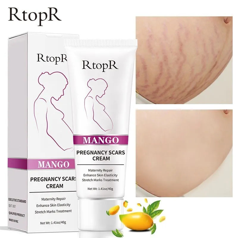 Mango Remove Pregnancy Scars Acne Cream Stretch Marks Treatment Maternity Repair Anti-Aging Anti-Winkles Firming Body Creams