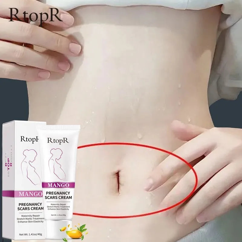 Mango Remove Pregnancy Scars Acne Cream Stretch Marks Treatment Maternity Repair Anti-Aging Anti-Winkles Firming Body Creams