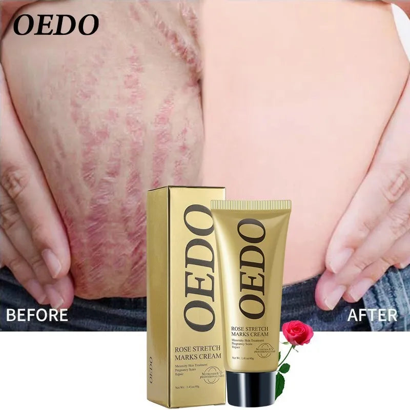 Rose Remove Stretch Marks Cream Anti Wrinkle Anti Aging Maternity Skin Repair Remove Pregnancy Scars Treatment Body Skin Care