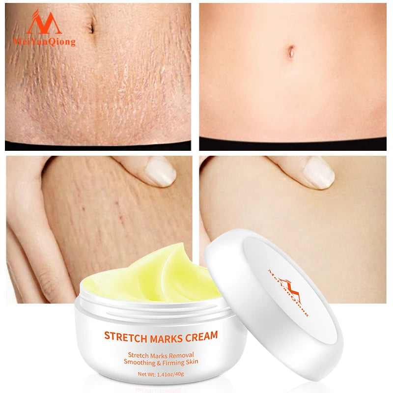 Pregnancy cream Removes Maternal Skin Repair Body Cream Removes Postpartum Scar Care Gentle Moisturizing Smooth skin